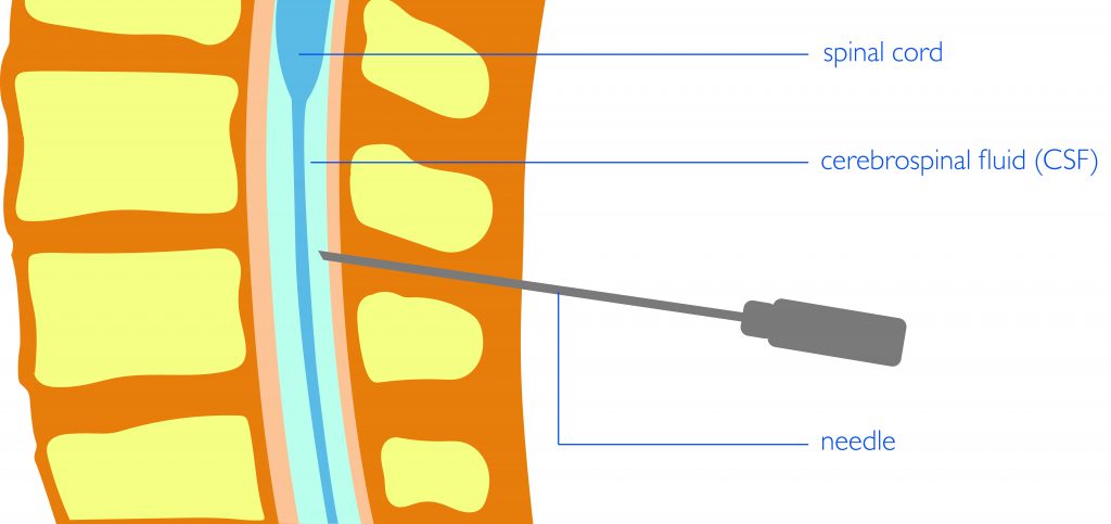 lumbar puncture side effects headache