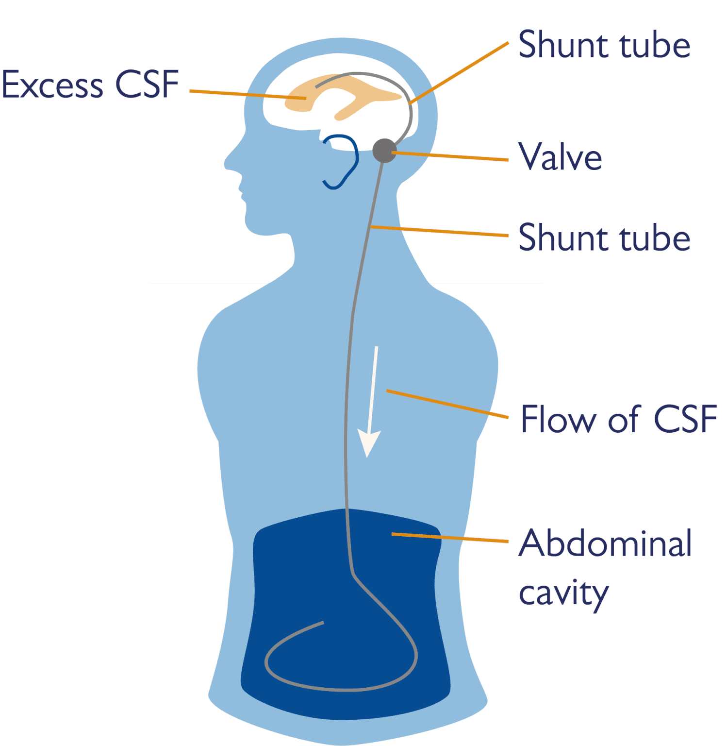 Hydrocephalus And Shunts Fact Sheet Health Information Brain